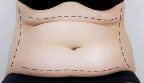 Your Journey to a Slimmer Figure: Tummy Tuck in Miami post thumbnail image