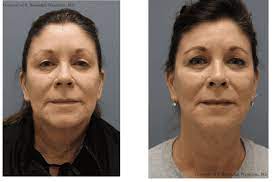 Effortless Glow-Up: Microneedling RF for Vibrant Skin post thumbnail image