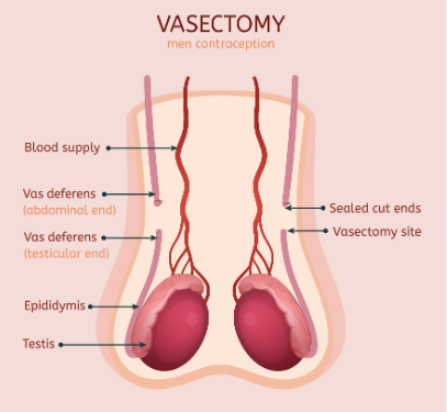 Regina’s Renewed Path to Parenthood: Vasectomy Reversal Choices post thumbnail image